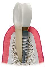 Diagram of a dental implant