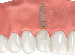 Diagram of a dental implant