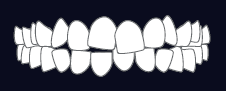 Crowded Teeth